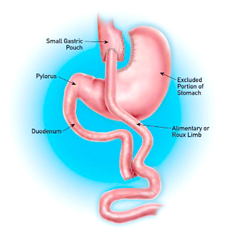 gastric roux bariatric bypass lifespan