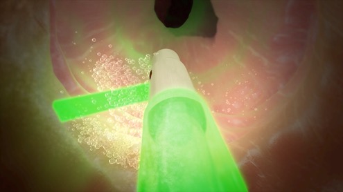 Greenlight Laser Prostatectomy Lifespan Minimally Invasive Urology Institute