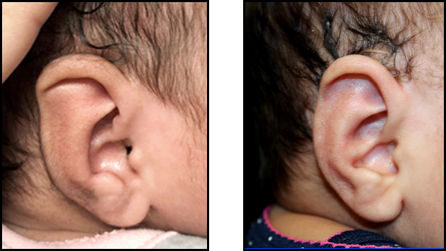Sound Options: Treating Abnormal Ear Shape in Infants and Children 